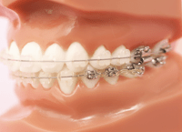 歯並びが身体に与える影響