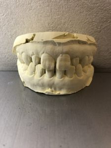 歯型